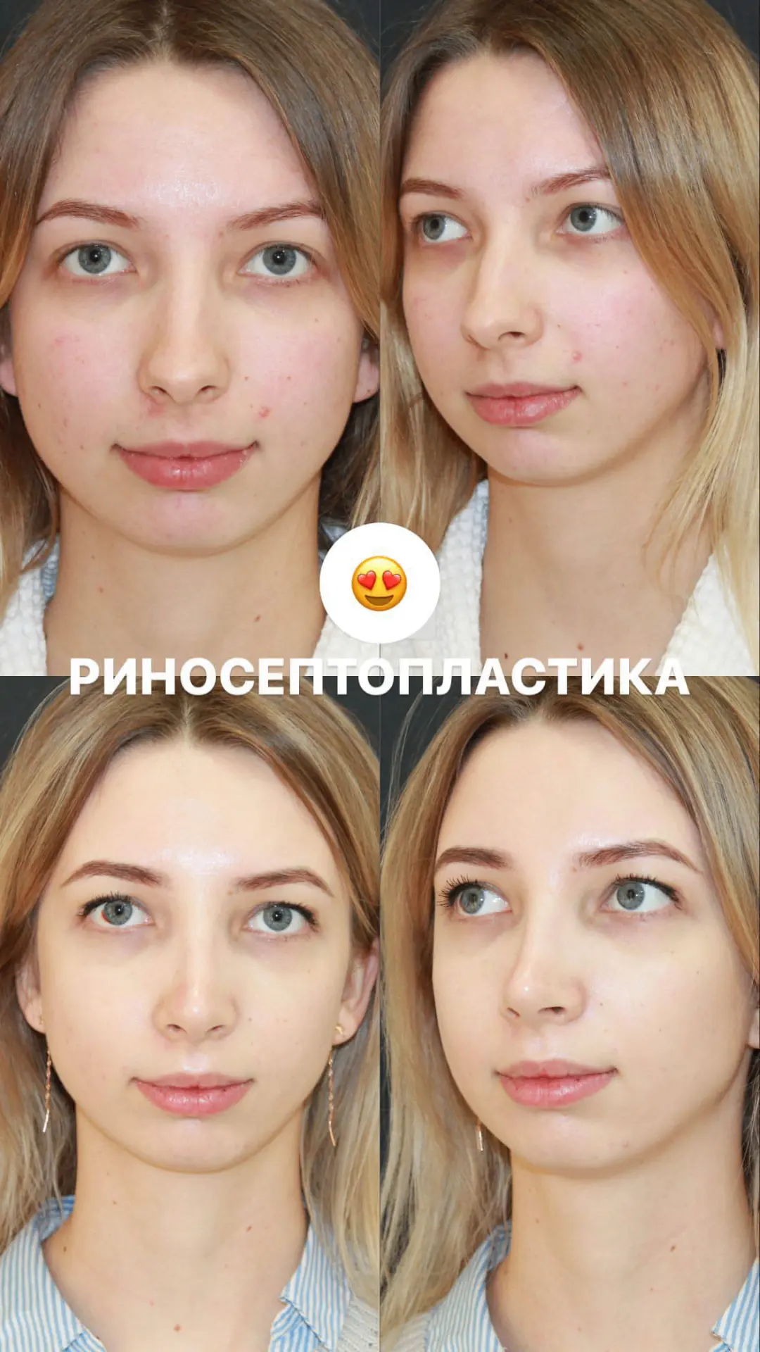 Результат риносептопластики 👃🏻