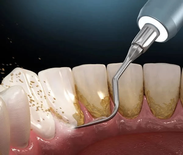 🦷 ЗУБНОЙ НАЛЁТ: ЧТО ОБРАЗУЕТСЯ НА ПОВЕРХНОСТИ ЗУБОВ?