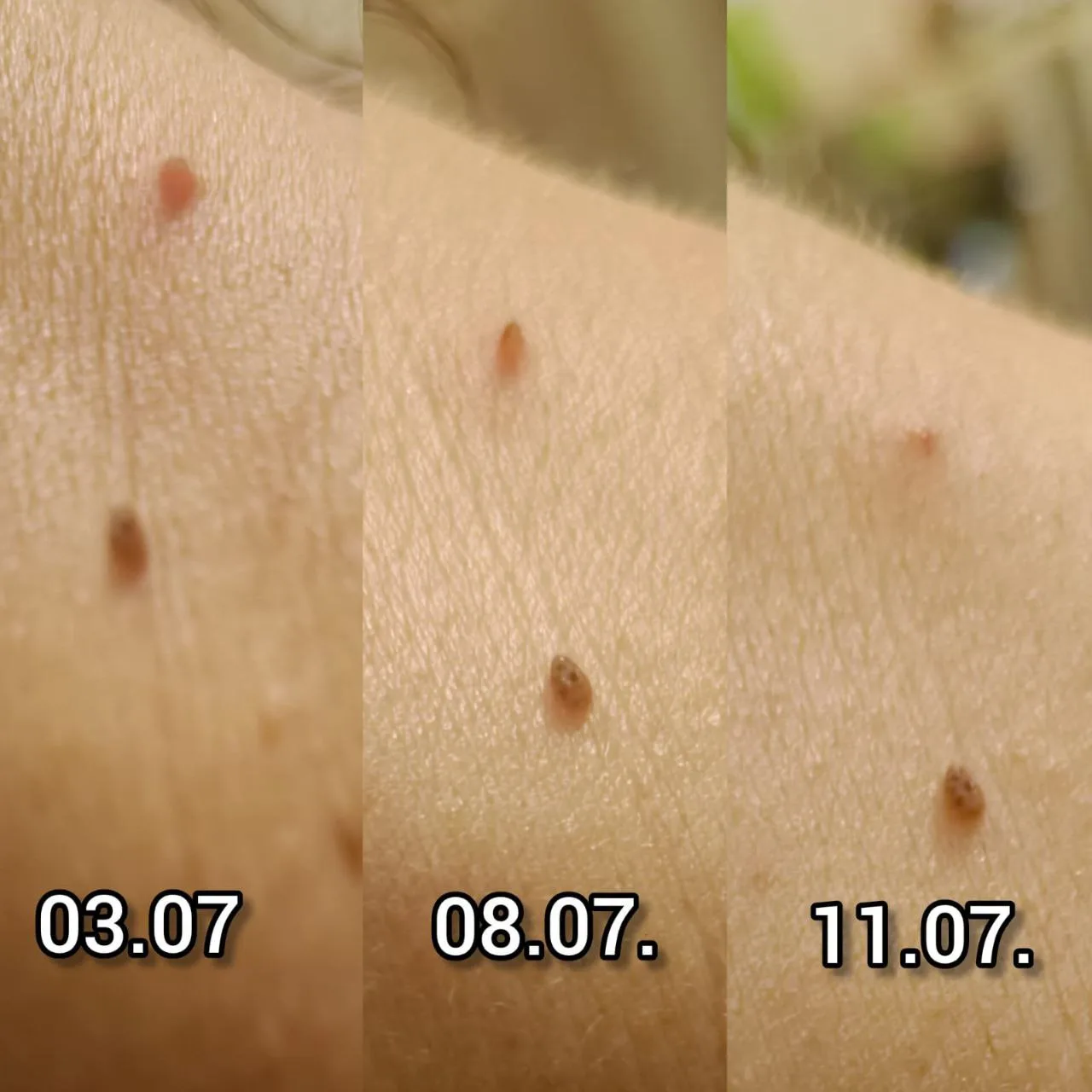 Результат по папилломе.