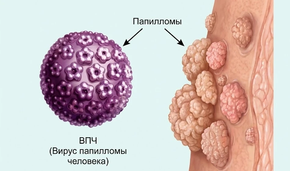 В России выпустили первую отечественную вакцину против вируса папилломы человека.