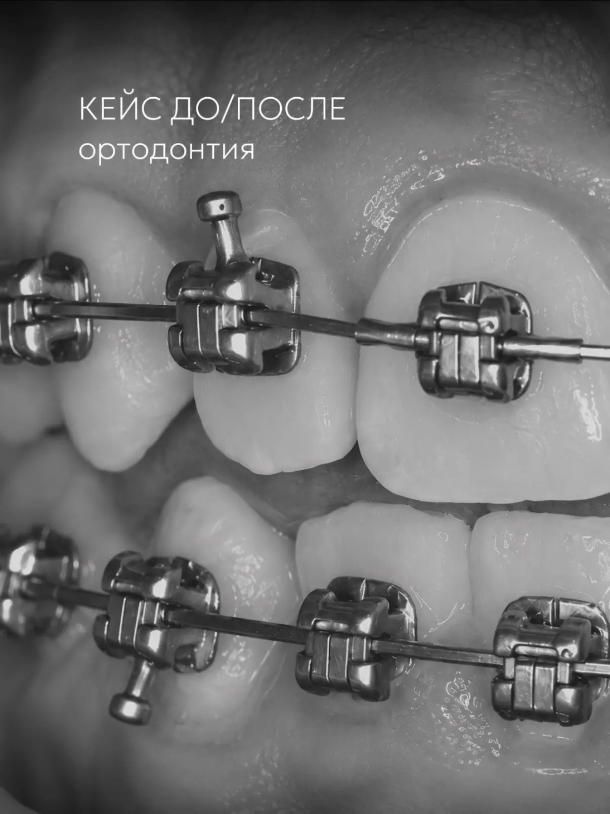 Даже при выраженной скученности и дефиците места ортодонтическое лечение позволяет посл...