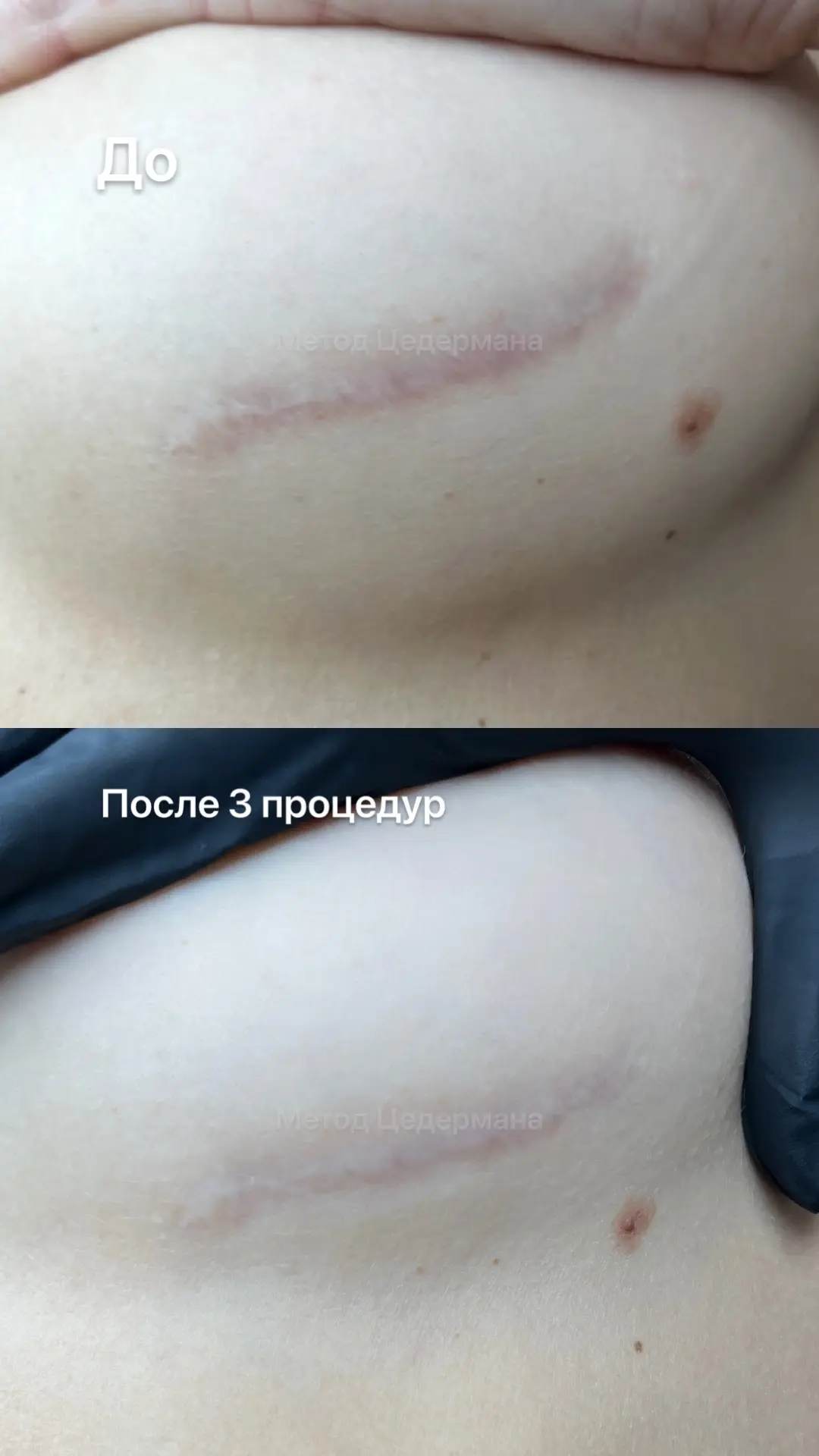 Результат 3 процедур CO₂-шлифовки