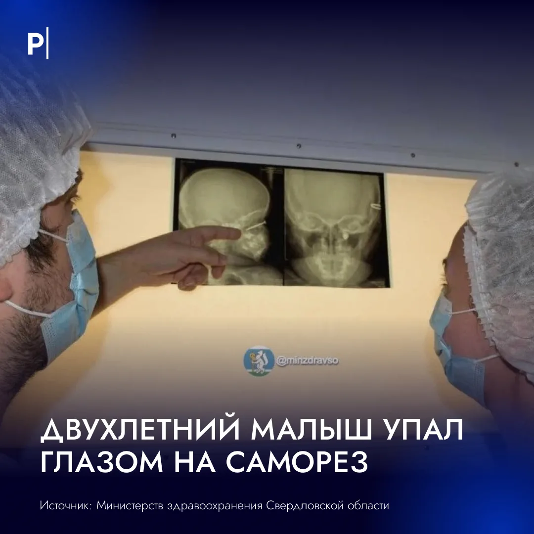 👶 Врачи спасли зрение двухлетнему мальчику, которому саморез попал прямо в глаз.