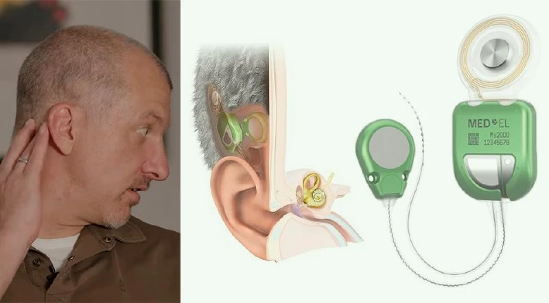 Австрийская компания Med-El сообщила о выпуске полностью имплантируемого кохлеарного им...