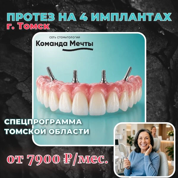 Имплантация всего зубного ряда на 4-х имплантах. Томск