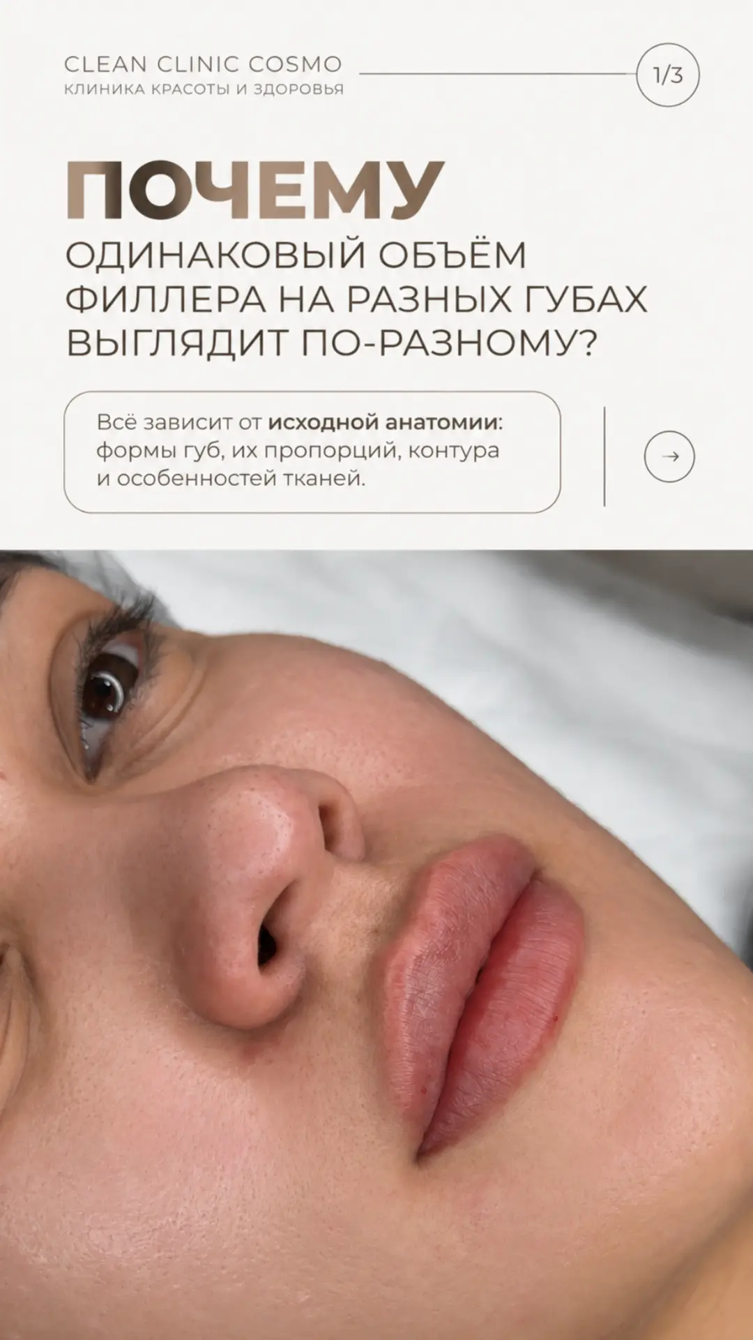 Контурная пластика губ 🫦