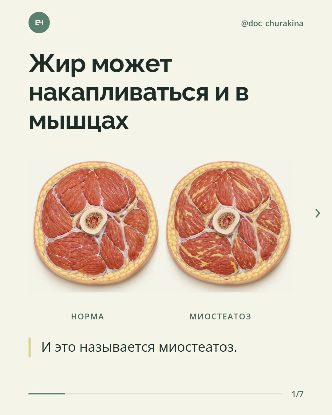 Есть одна тема про мышцы, о которой говорят гораздо реже, чем про саркопению.