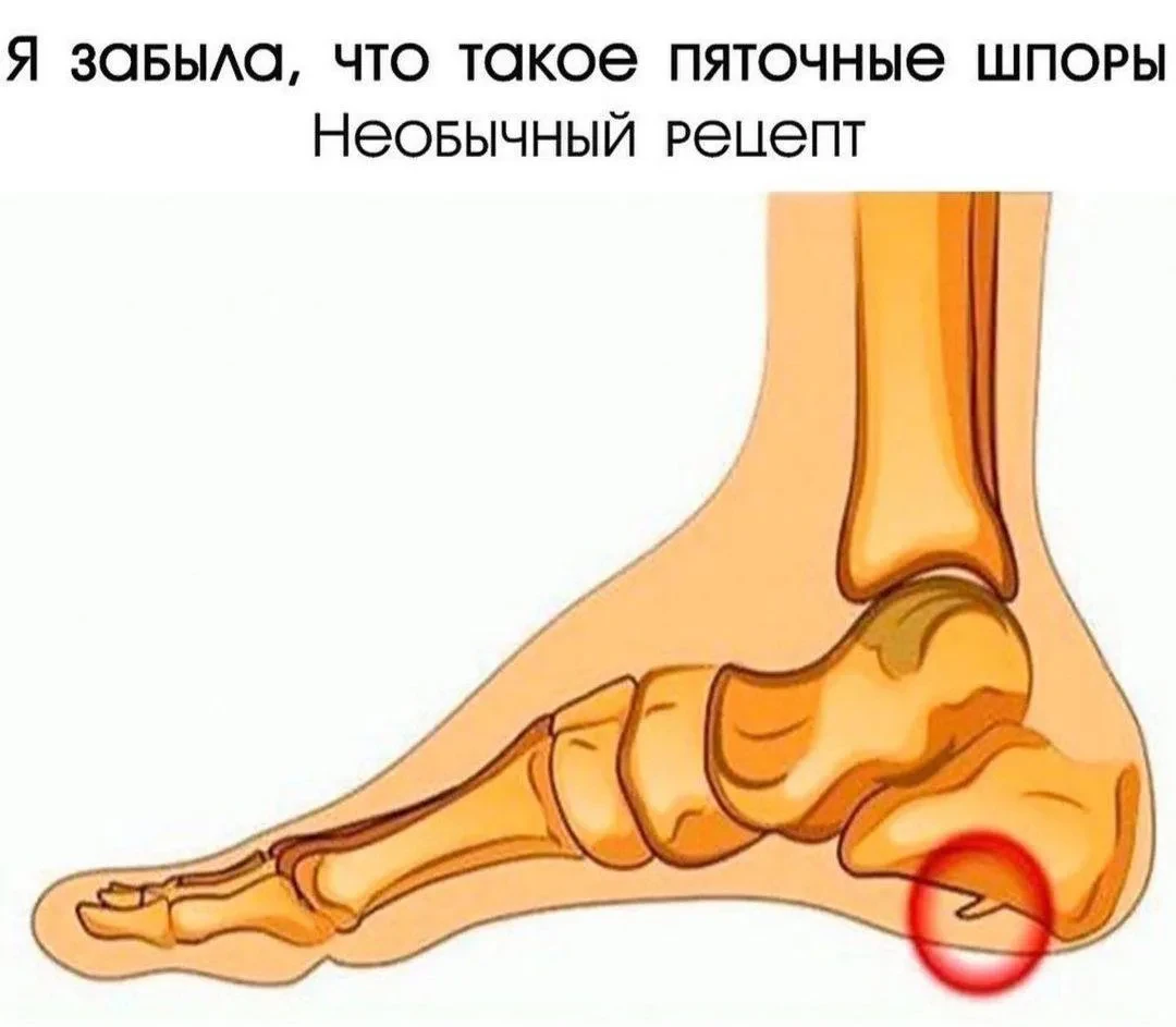 ❗️Я забыла, что такое пяточные шпоры!