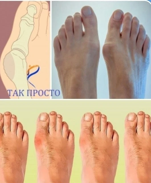 🌞5 СПОСОБОВ ИЗБАВИТЬСЯ ОТ КОСТОЧКИ НА НОГЕ БЕЗ ПОМОЩИ ХИРУРГА.
