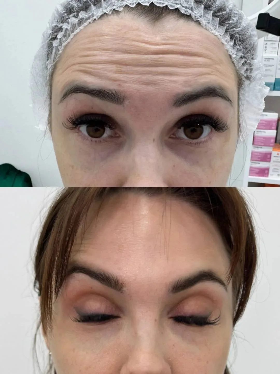 БОТОКС 💉