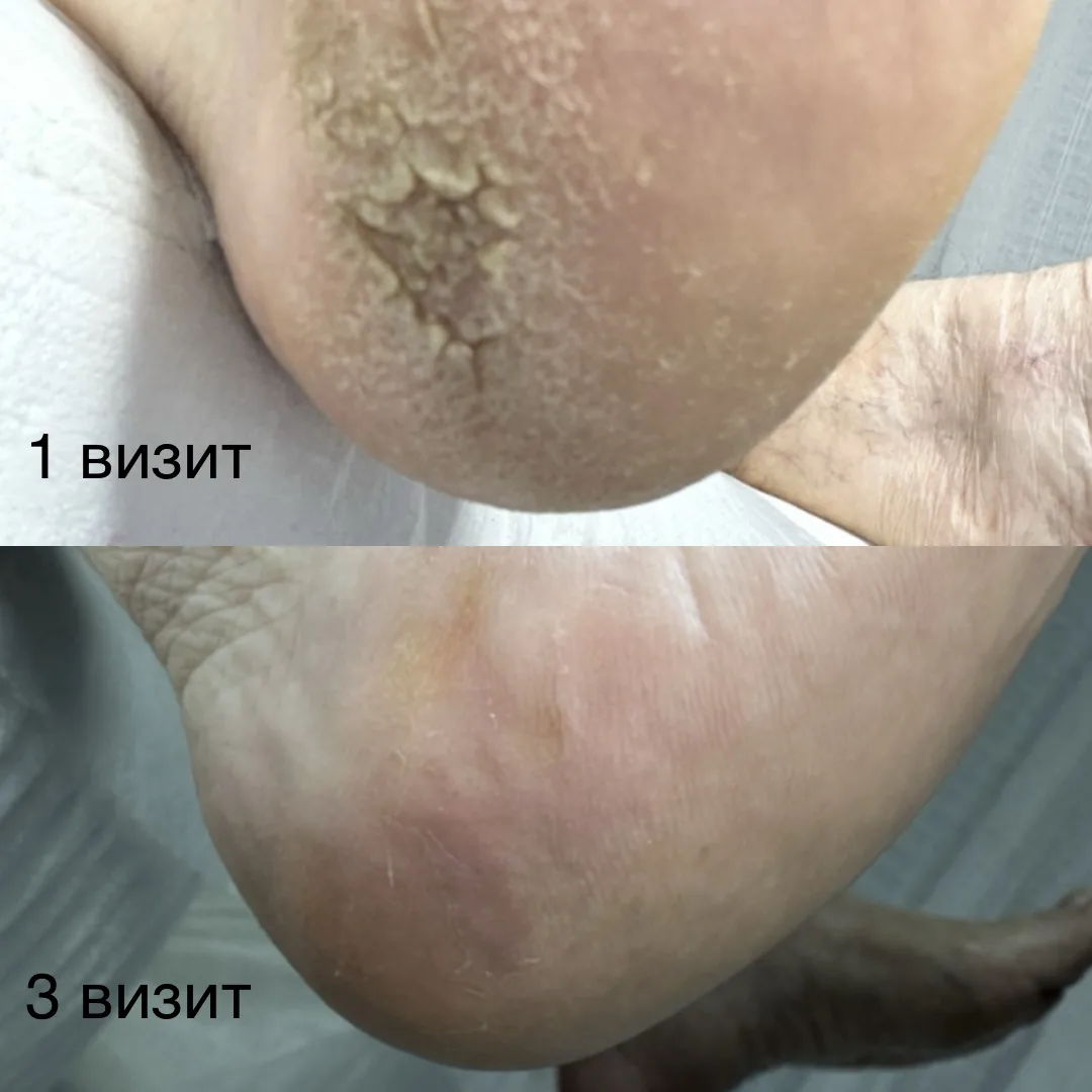 Почему нельзя убирать полностью ороговевший слой кожи стопы при педикюре.