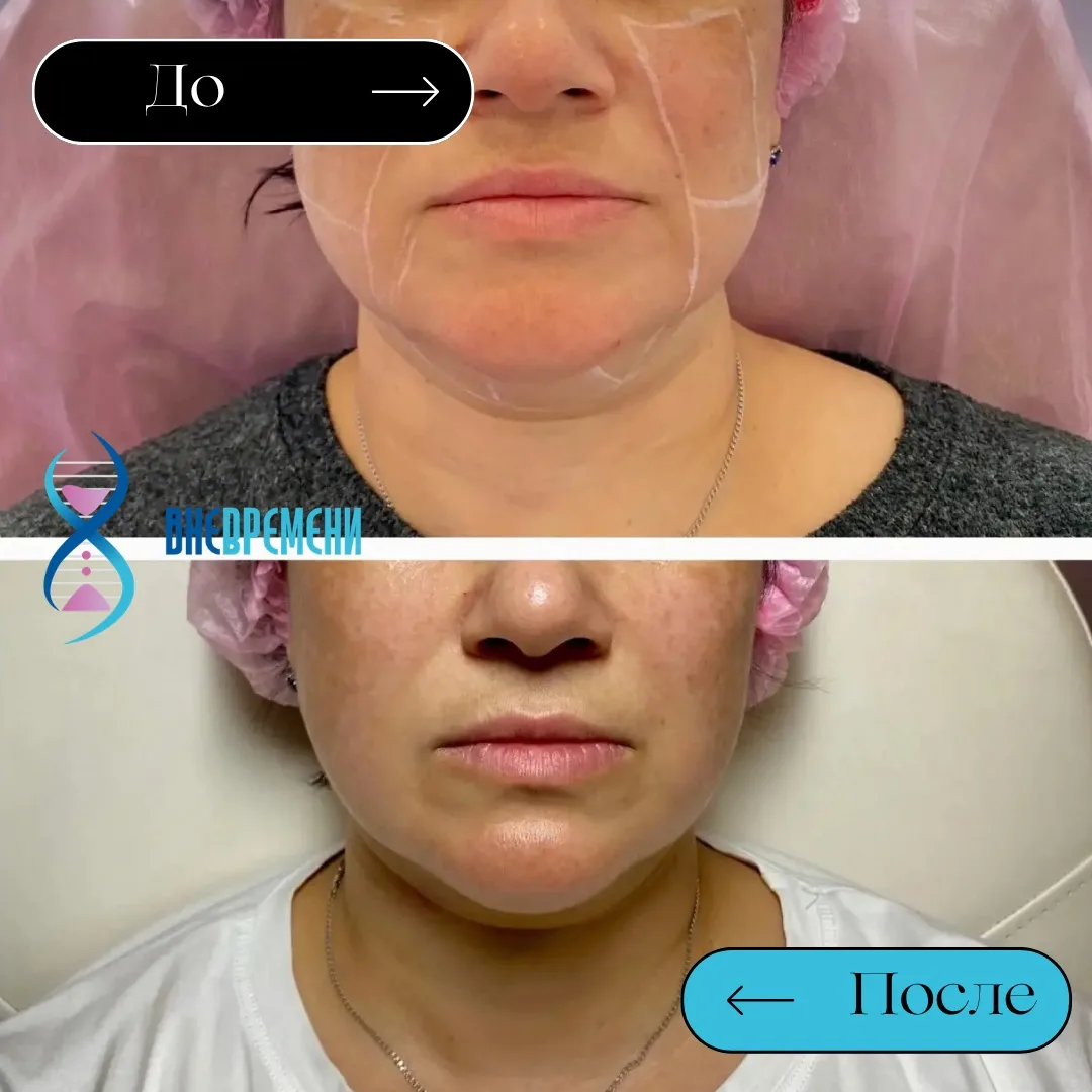 Безоперационно подтянули нижнюю треть лица у 49-летней пациентки 👇