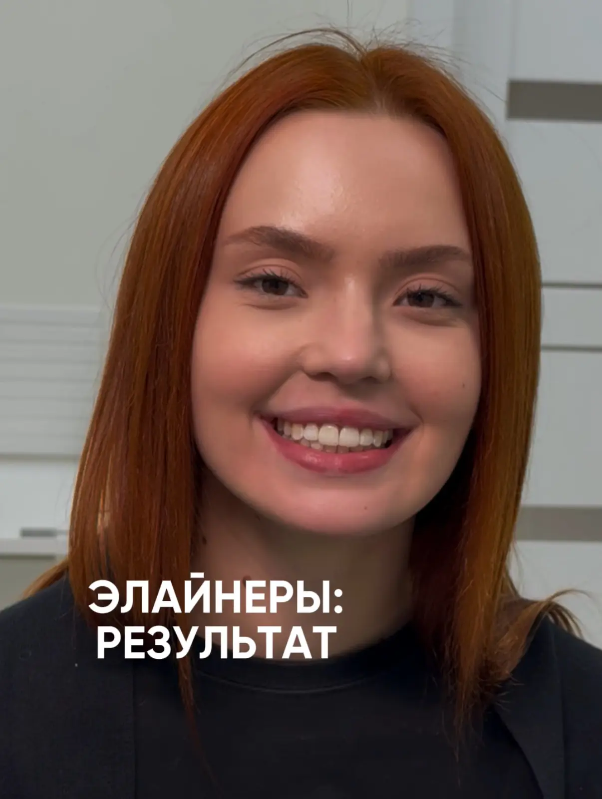 Ортодонтическое лечение на элайнерах завершено ✨