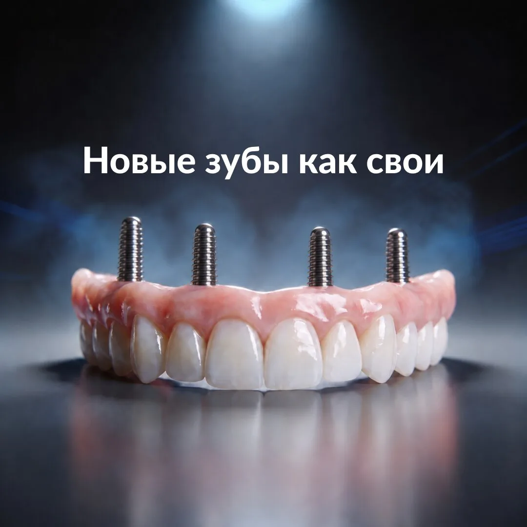 Всего 4 импланта для восстановления всех зубов!