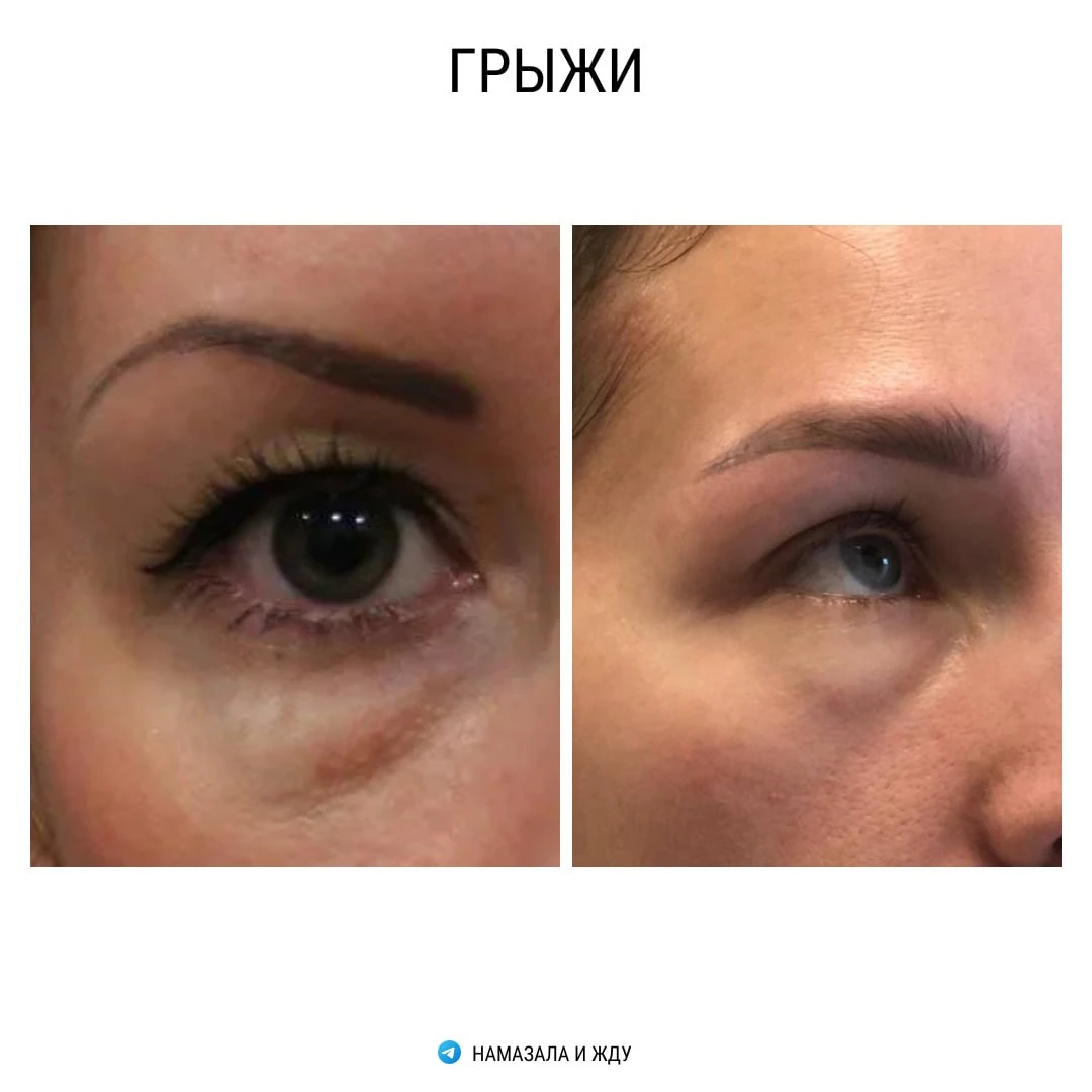 Грыжи (мешки под глазами)