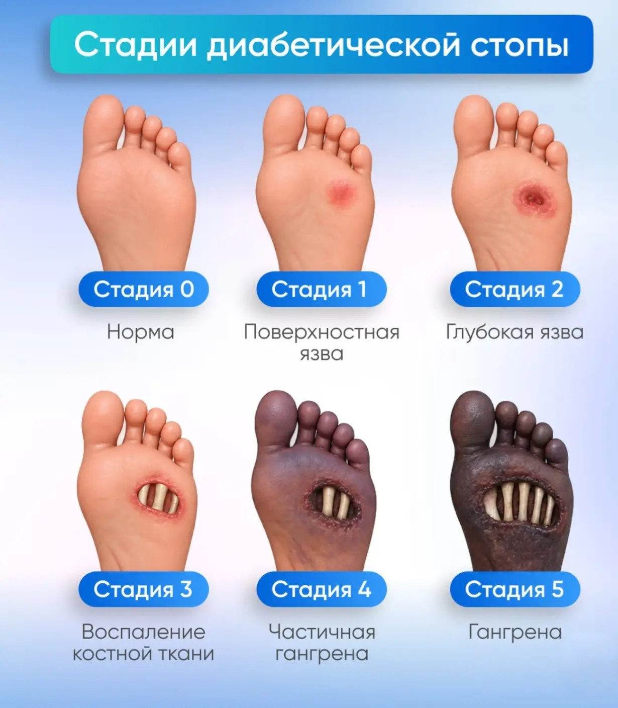 Стадии диабетической стопы (по Вагнеру):