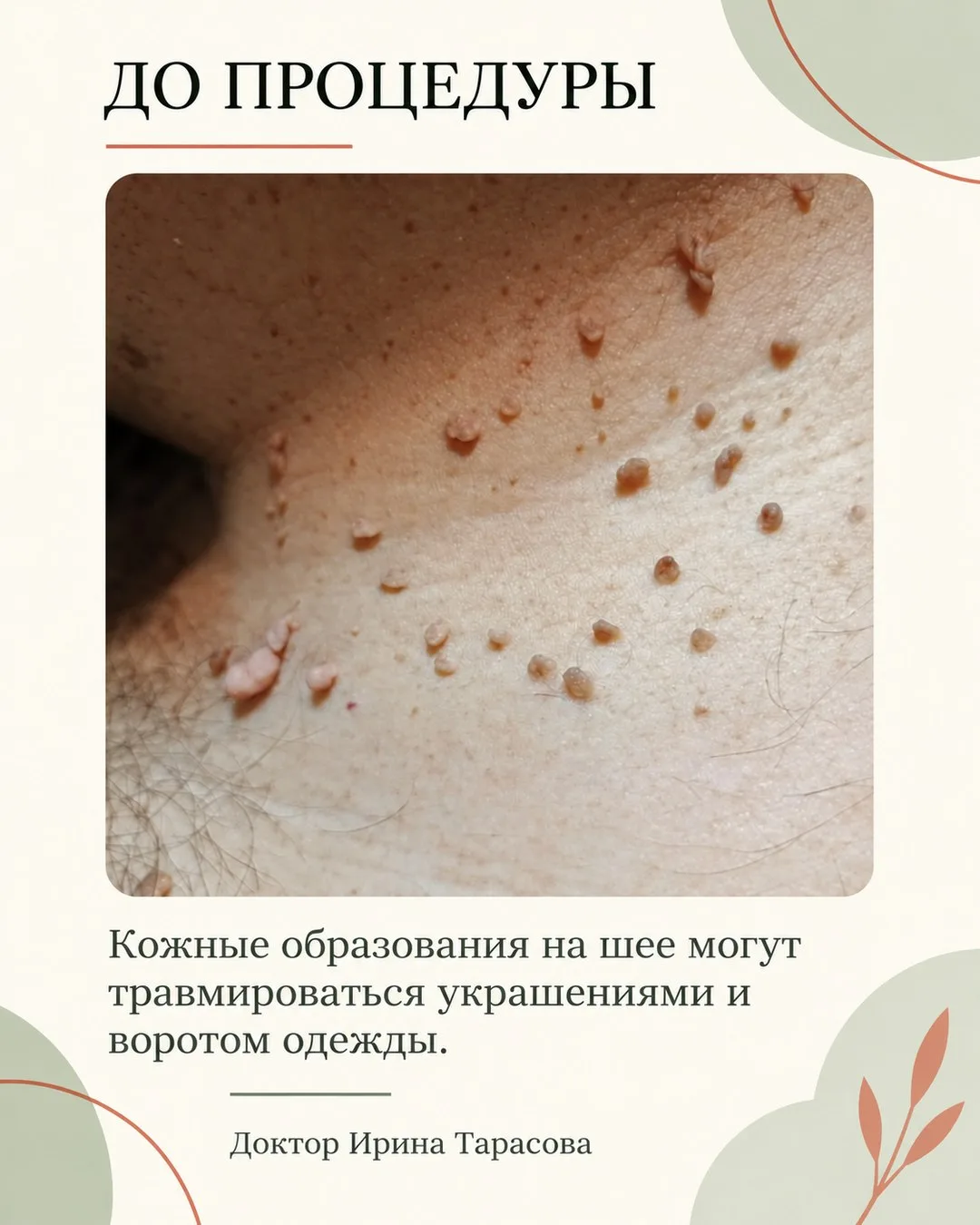 Мои дорогие, сегодня покажу результат удаления кожных образований на шее методом электр...