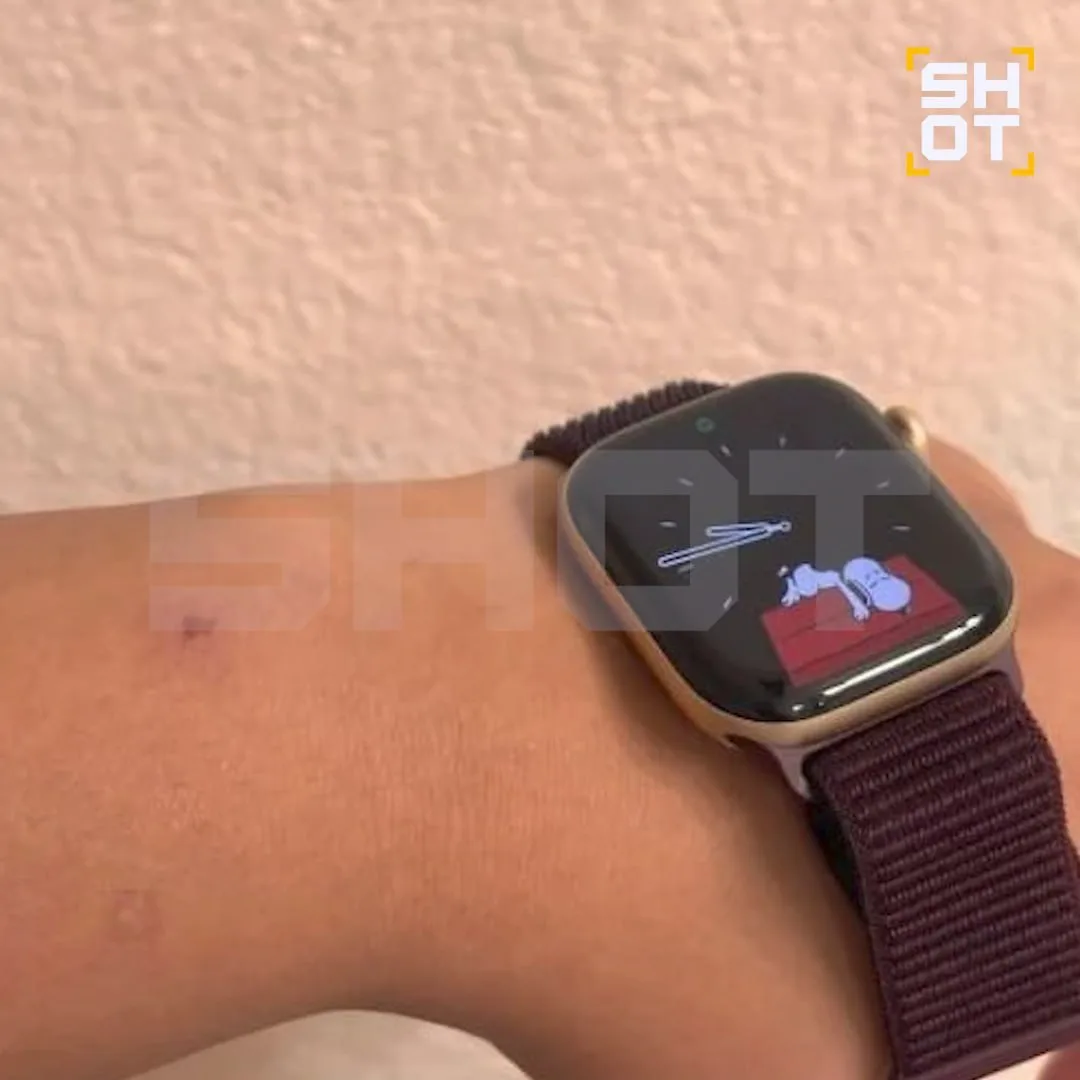 😮 Россияне массово жалуются на раздражение кожи от новых Apple Watch, сообщает Shot.