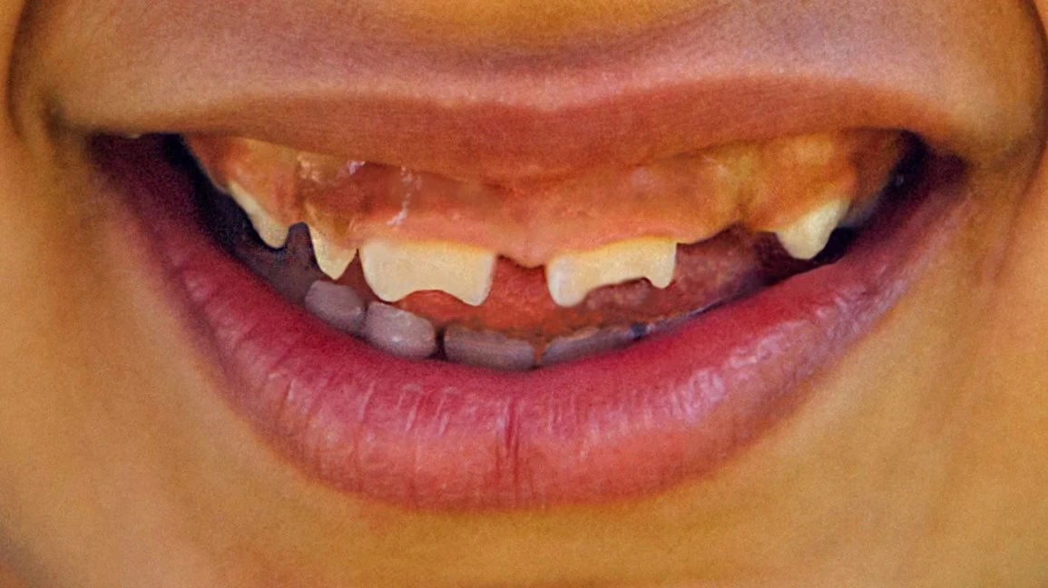 Какие бывают аномалии зубов?🦷