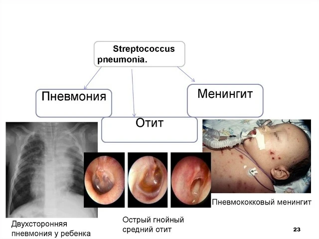 Пневмококковая инфекция крайне неприятна в любом возрасте, но особенно опасна для детей...