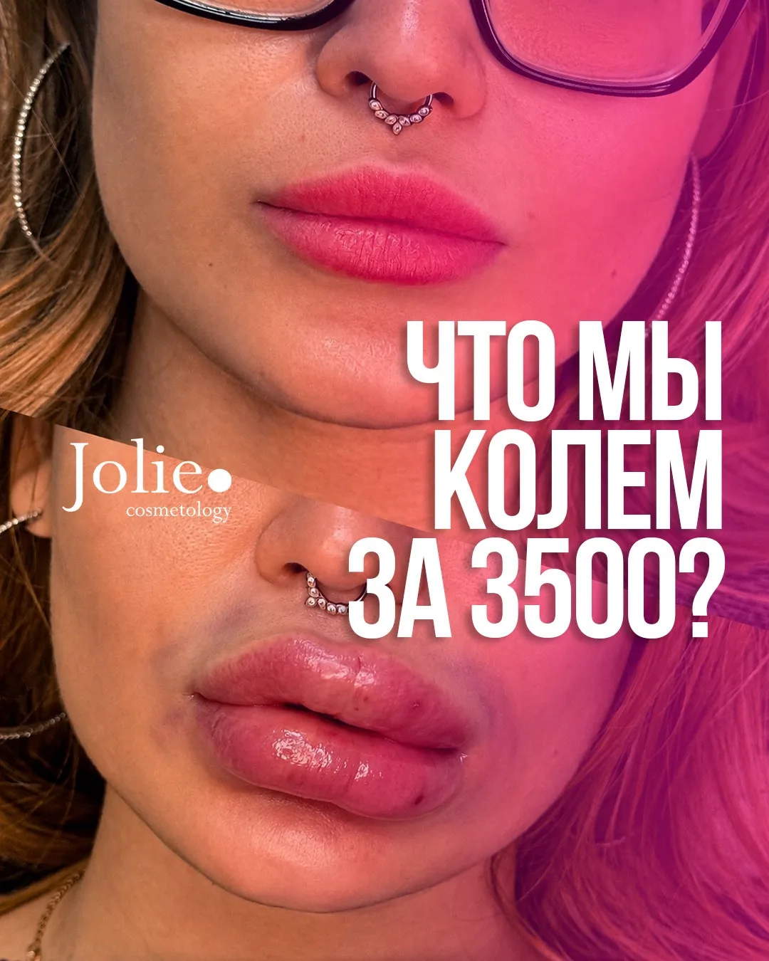 😱Что @jolie_cosmetology там колет за 3500?