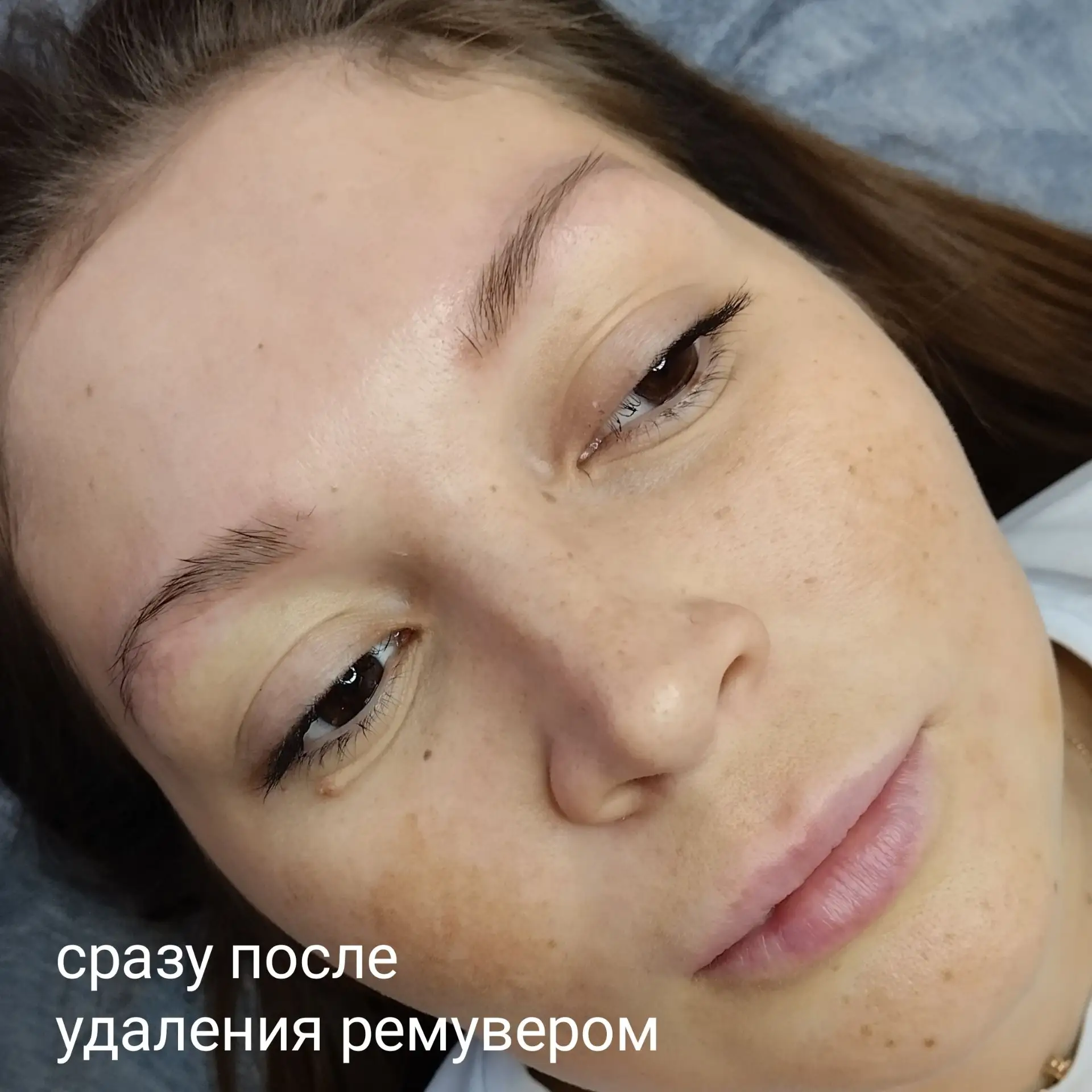 УДАЛЕНИЕ РЕМУВЕРОМ НЕЖЕЛАТЕЛЬНОГО ЦВЕТА БРОВЕЙ ПОСЛЕ ТАТУАЖА