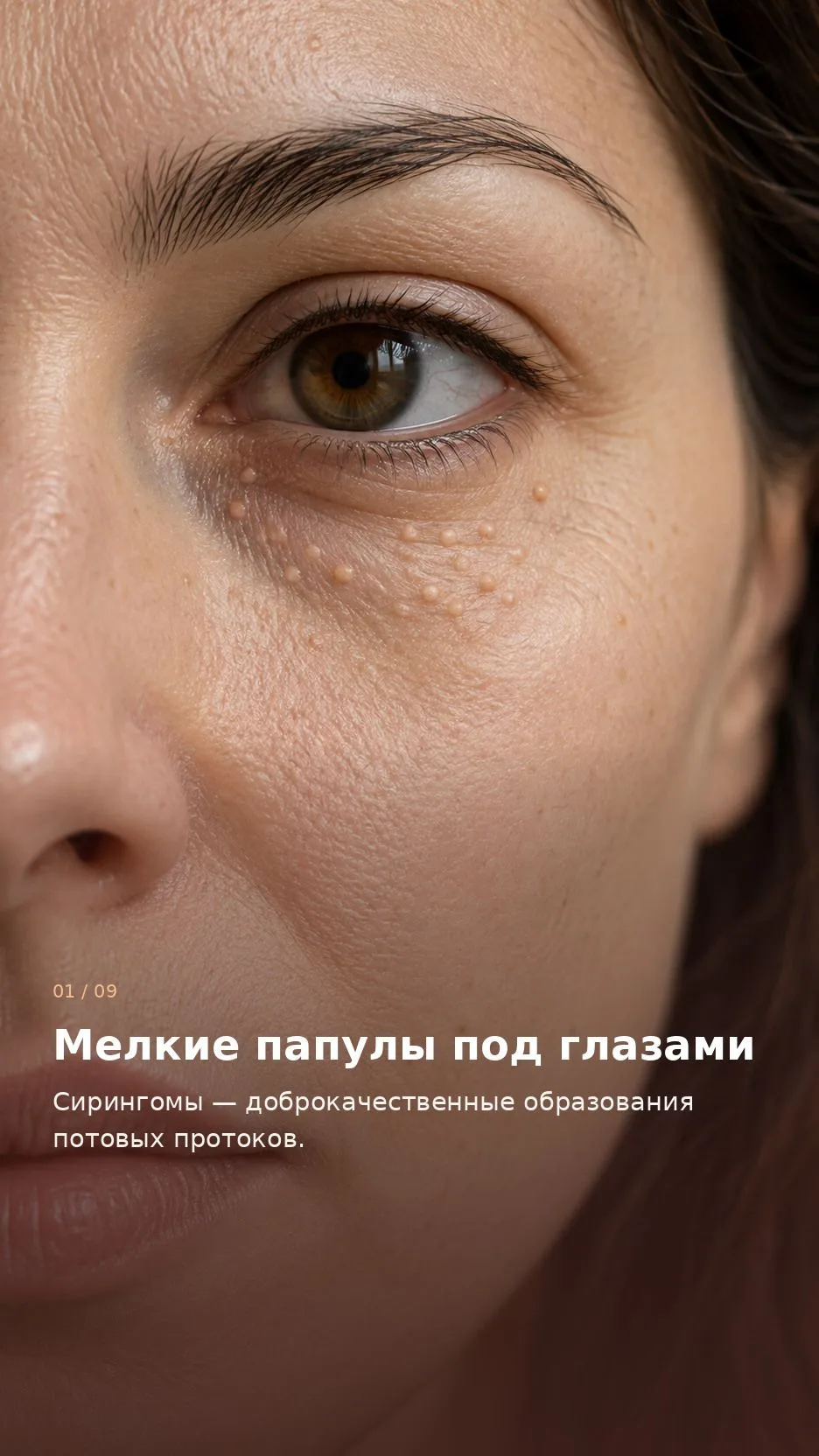 Сирингомы век