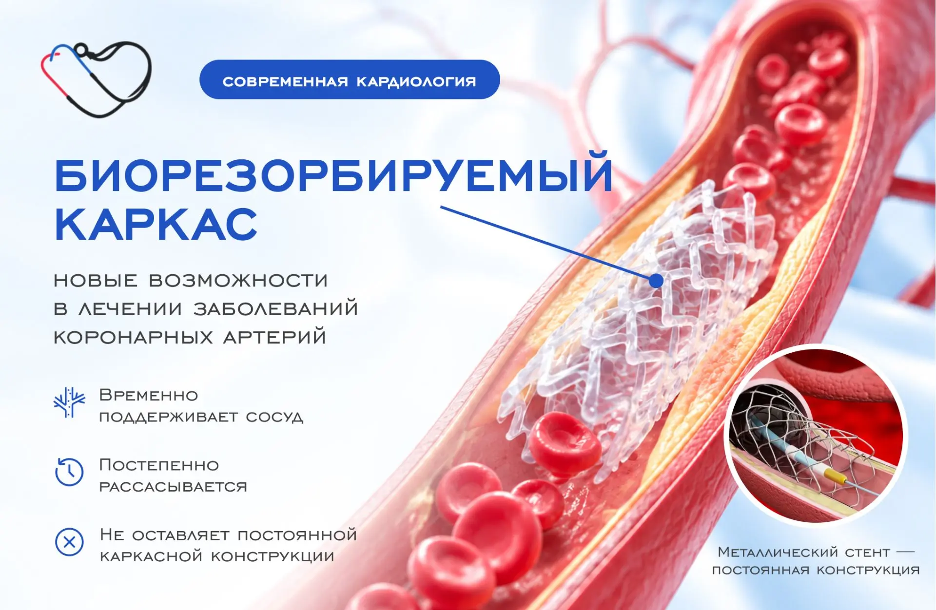 Биорезорбируемый каркас: новые возможности в лечении заболеваний коронарных артерий 🧬