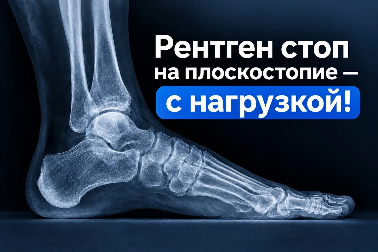 👨‍⚕️Рентген стоп на плоскостопие — с нагрузкой! Только так можно точно определить степ...
