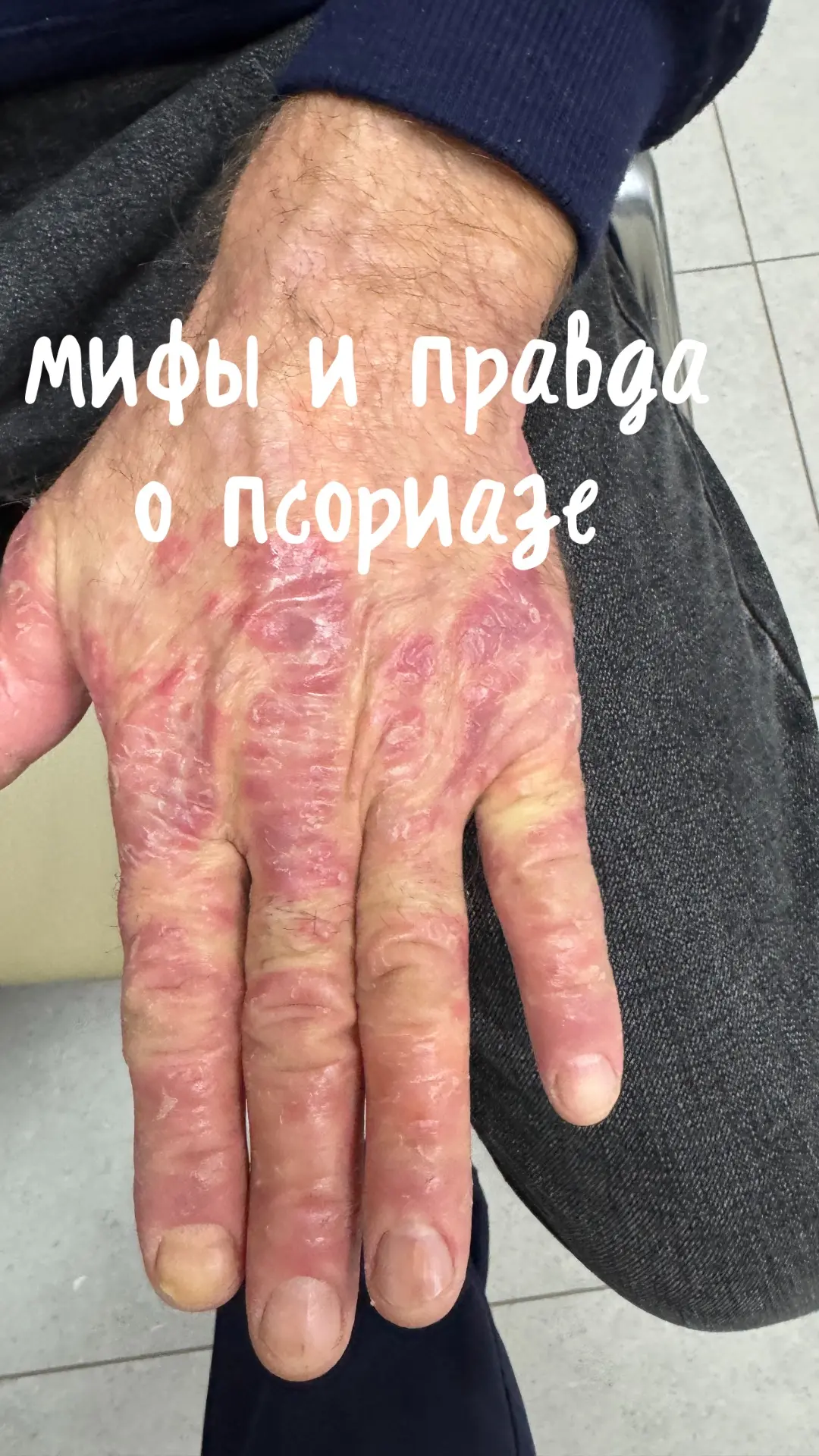«Доктор, это заразно?» — Нет. Ни при рукопожатии, ни через вещи, ни по воздуху. Это ген...