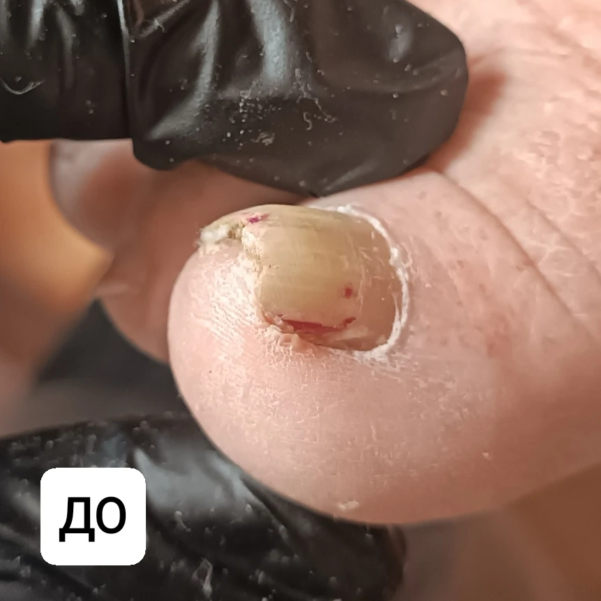 🍄 Грибок ногтей на ногах может долго оставаться незамеченным.