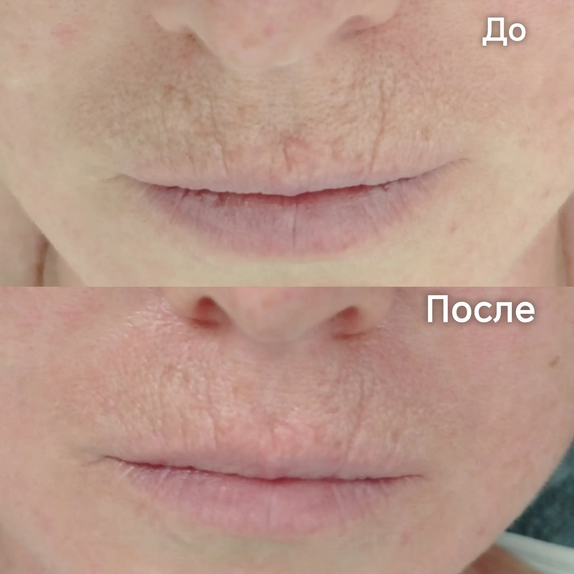 Тот же массаж, только уже кисетные морщины