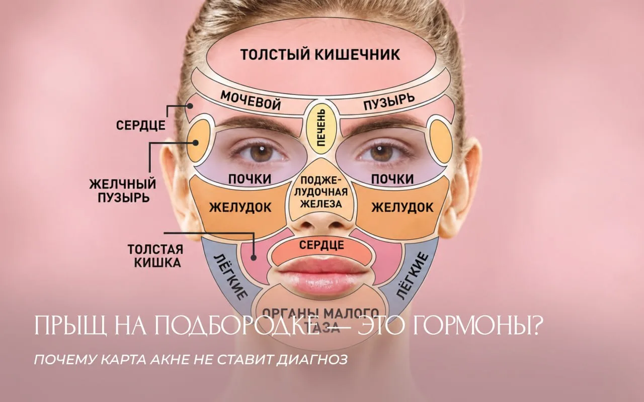 Прыщ на подбородке — это гормоны? TikTok-диагностика стала слишком простой