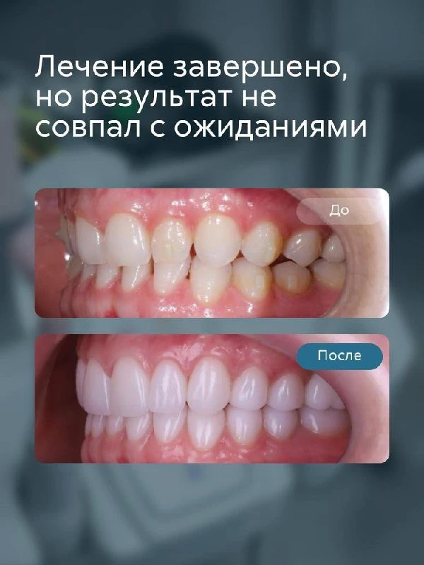 🦷 После лечения на элайнерах в другой клинике Анна осталась недовольна эстетикой улыбки.