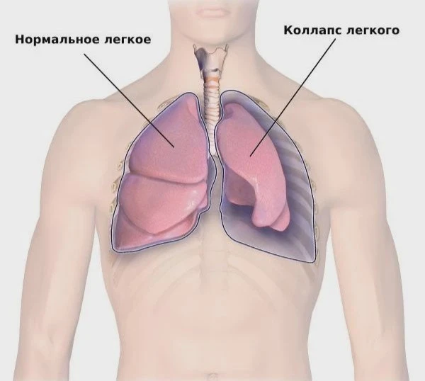 Вейпы и болезни лёгких у молодых