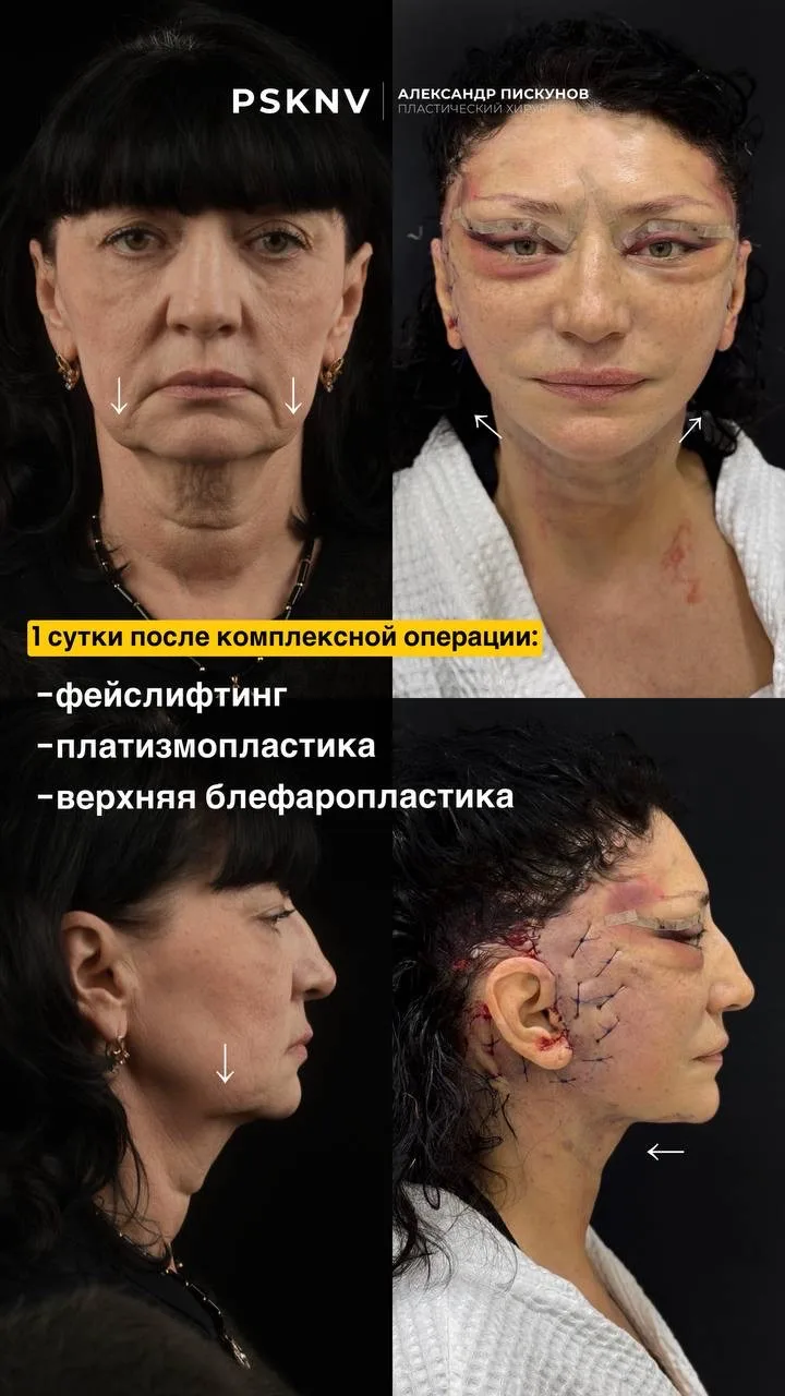 1 месяц после фейслифтинга( DEEP SMAS), платизмопластики, височного лифтинга и блефароп...