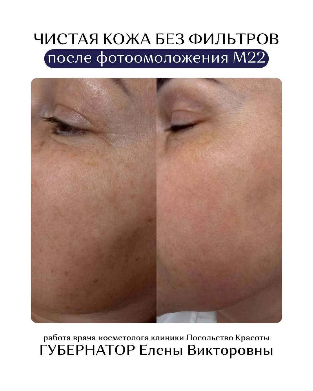 ЧИСТАЯ КОЖА БЕЗ ФИЛЬТРОВ ✨