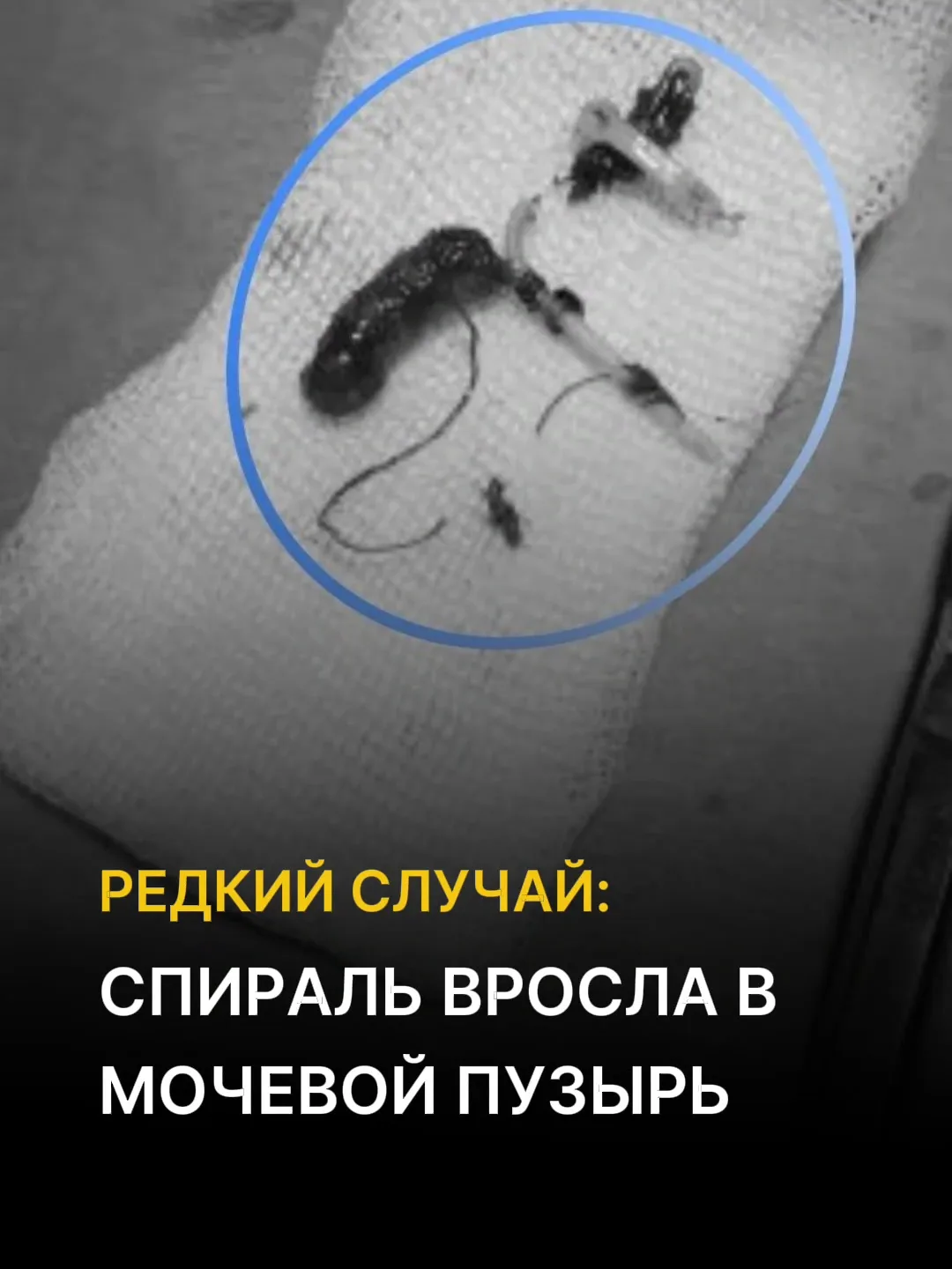 ⚡️Спираль вросла в мочевой пузырь: в Сургуте провели уникальную операцию