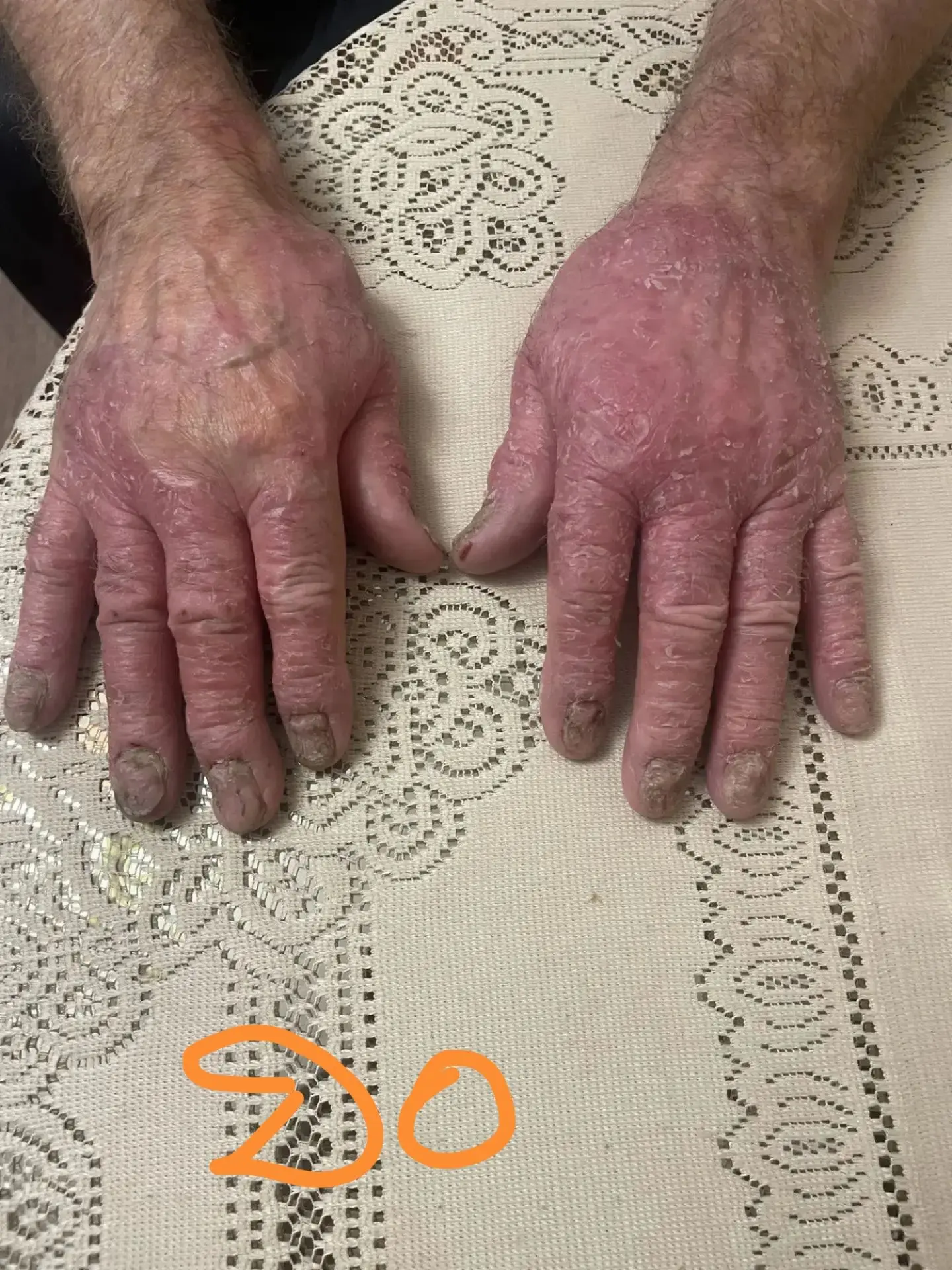 Мужчина, 75 лет. Тяжелый псориаз на руках и ногах. Помог ТОЛЬКО Хемохим! (До / После)»