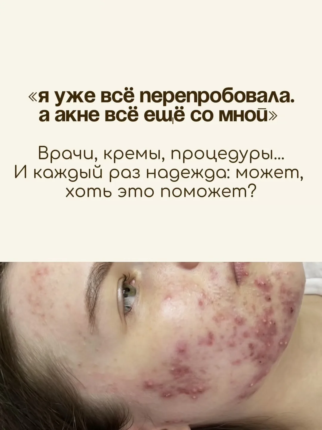 Я не оставляю своих пациенток наедине с акне: мы детально разбираем ошибки прошлого, ст...
