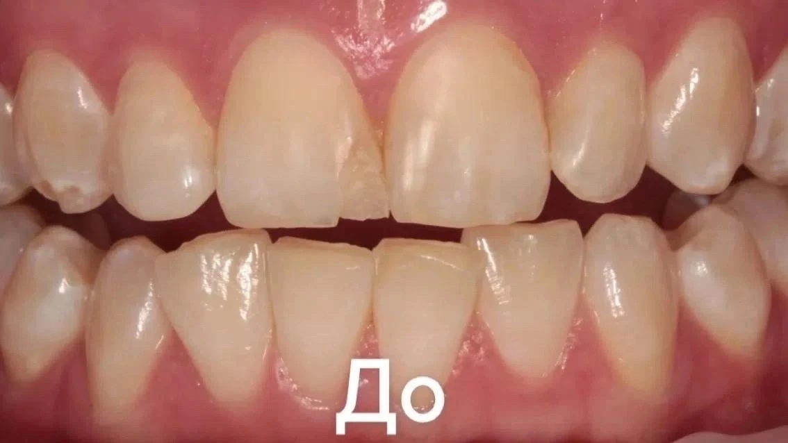 Страшно не само лечение, а то, во что превращается зуб, если затягивать.