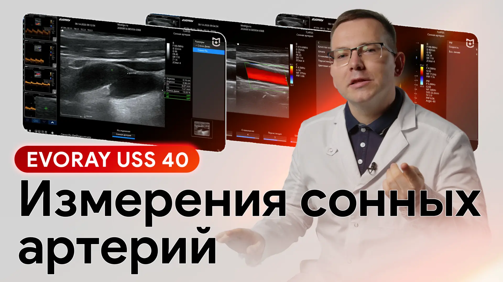 ⚡️Проверка EVORAY USS 40 на практике: как аппарат справляется с УЗИ сонных артерий