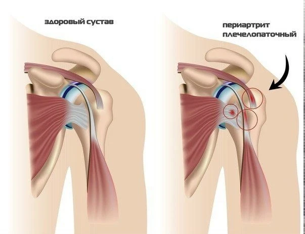 ПЛЕЧЕЛОПАТОЧНЫЙ ПЕРИАРТРИТ
