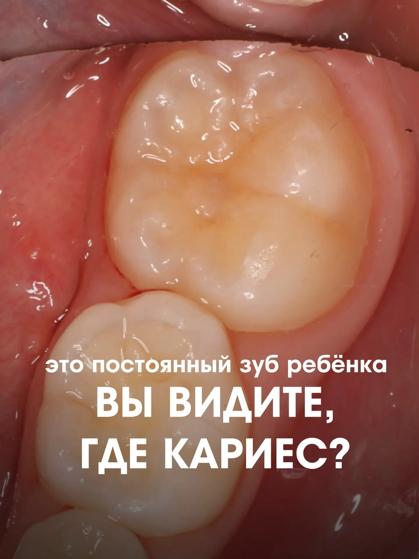 Мало того, что кариес может не болеть, так его ещё и не всегда можно заметить! 👀