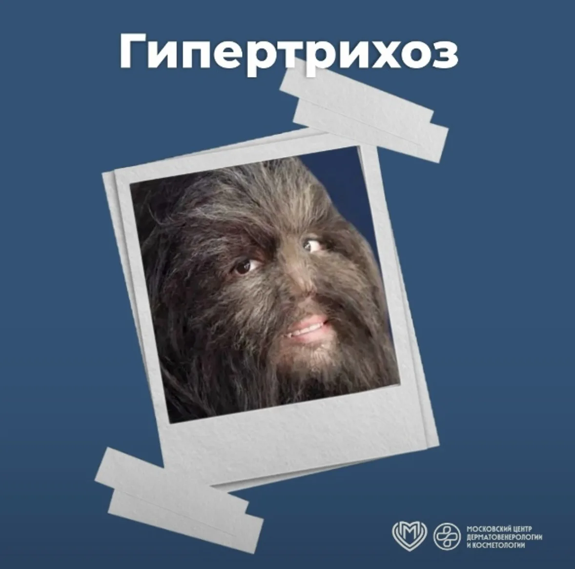 😓Избыточный рост волос на теле может быть не только эстетическим недостатком, но и сим...