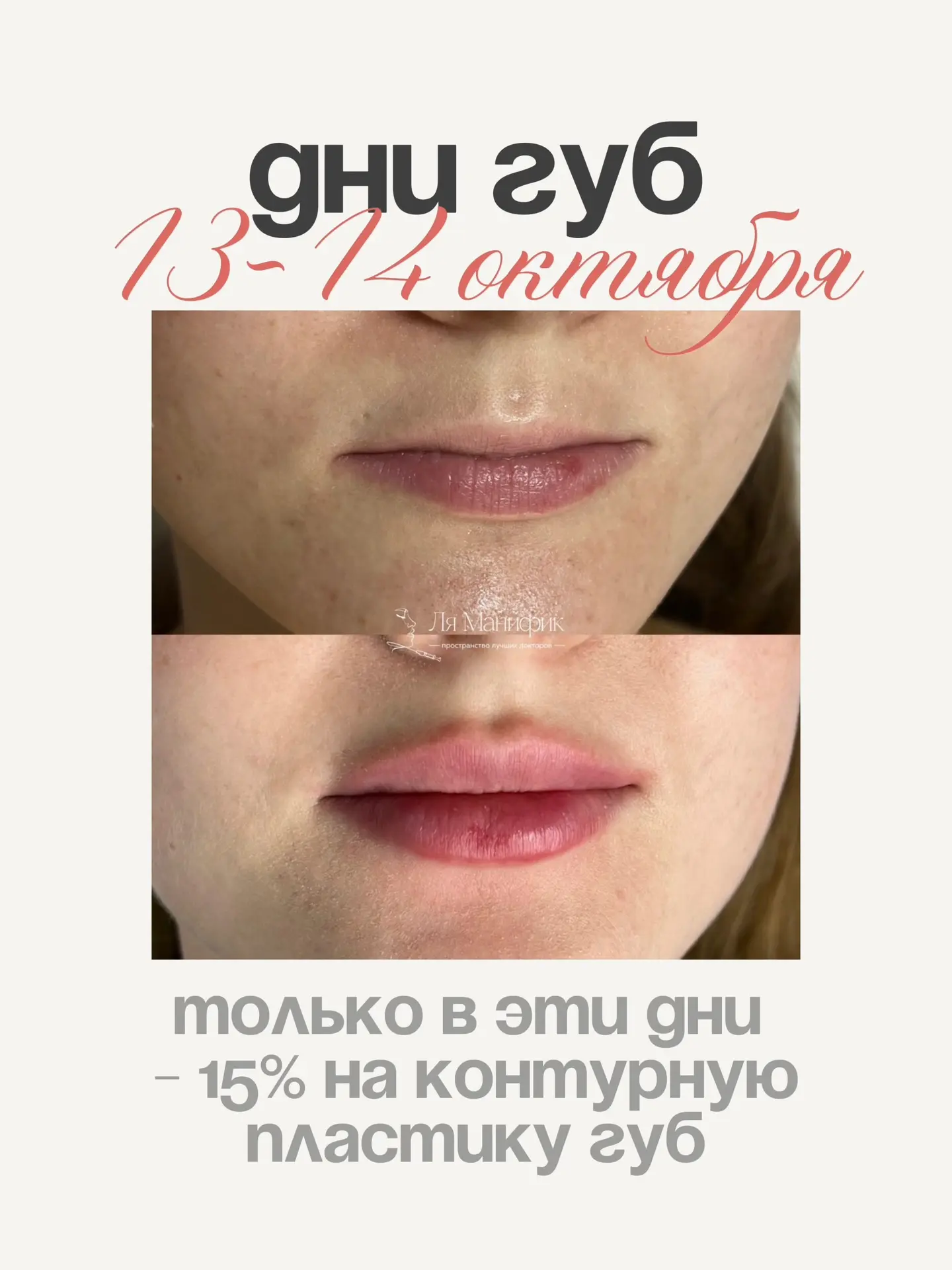 -15% на увеличение губ