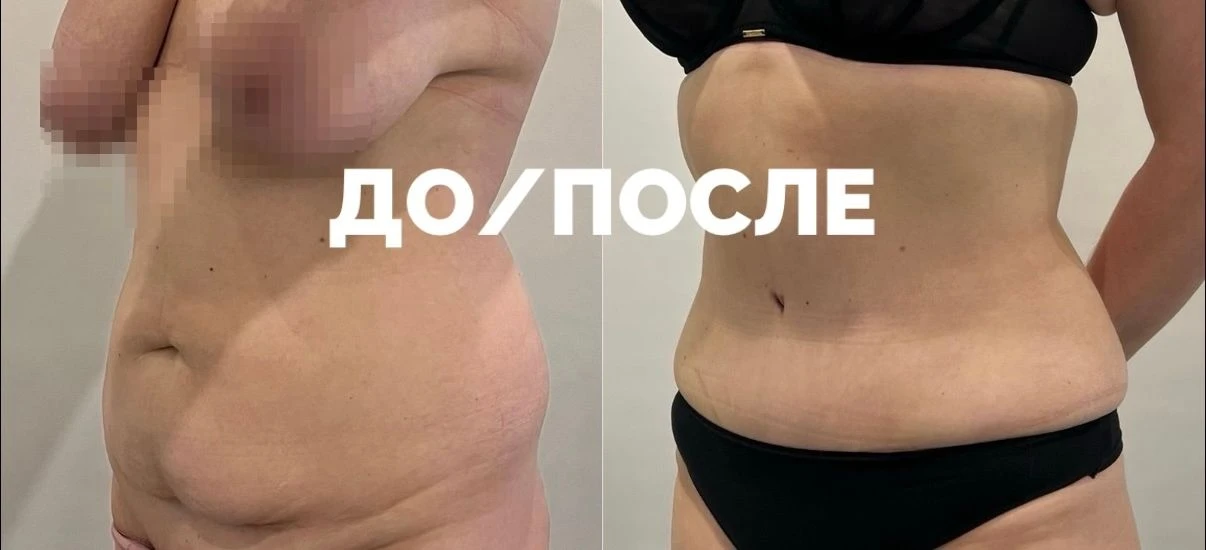 Результат после абдоминопластики