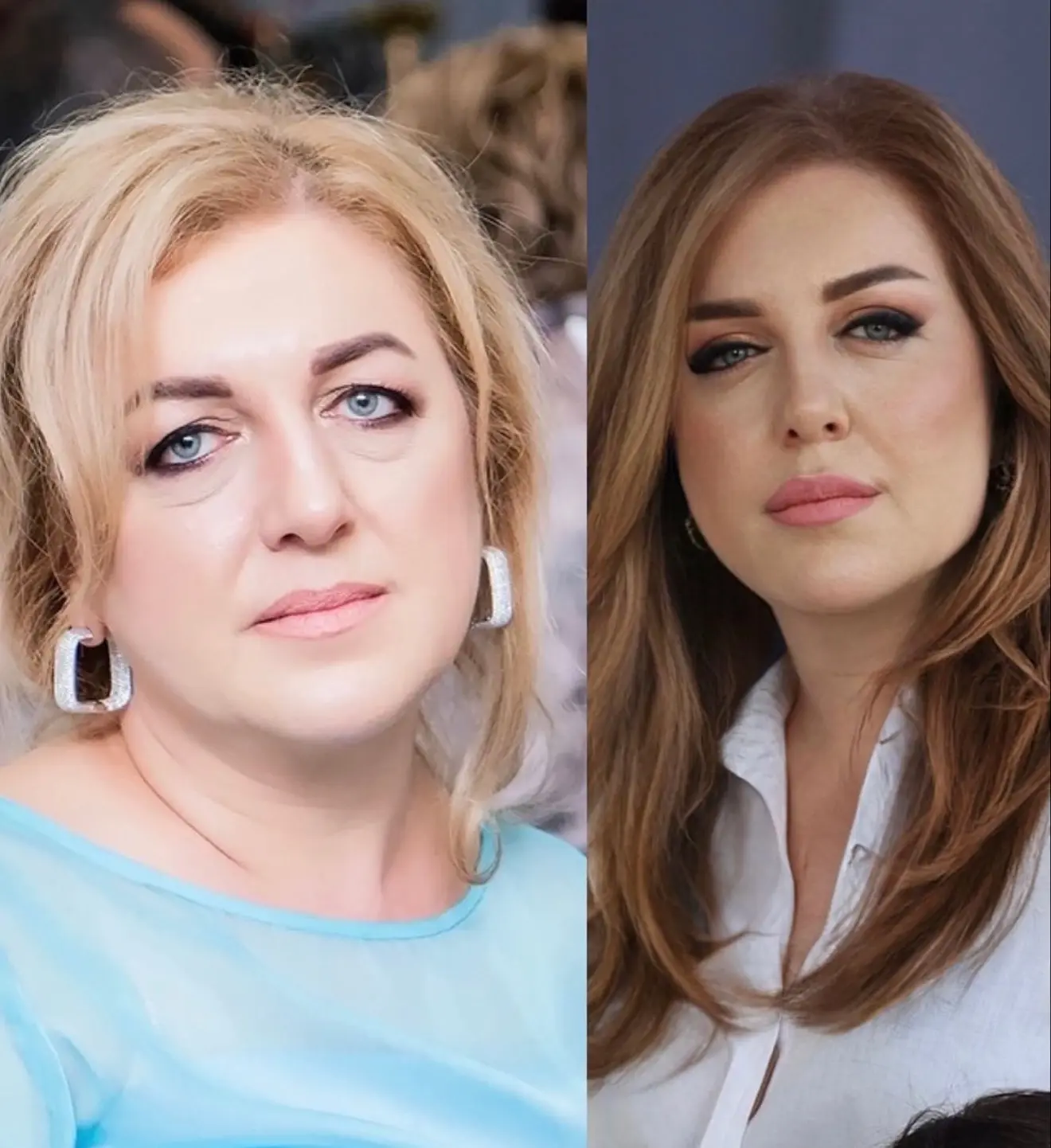 Блефаропластика была моей мечтой…