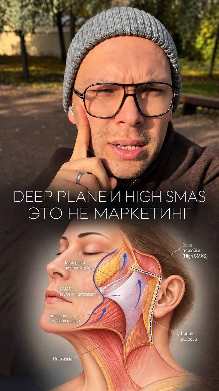 Deep plane и High SMAS - это не маркетинговые названия, те кто думает по-другому- либо ...