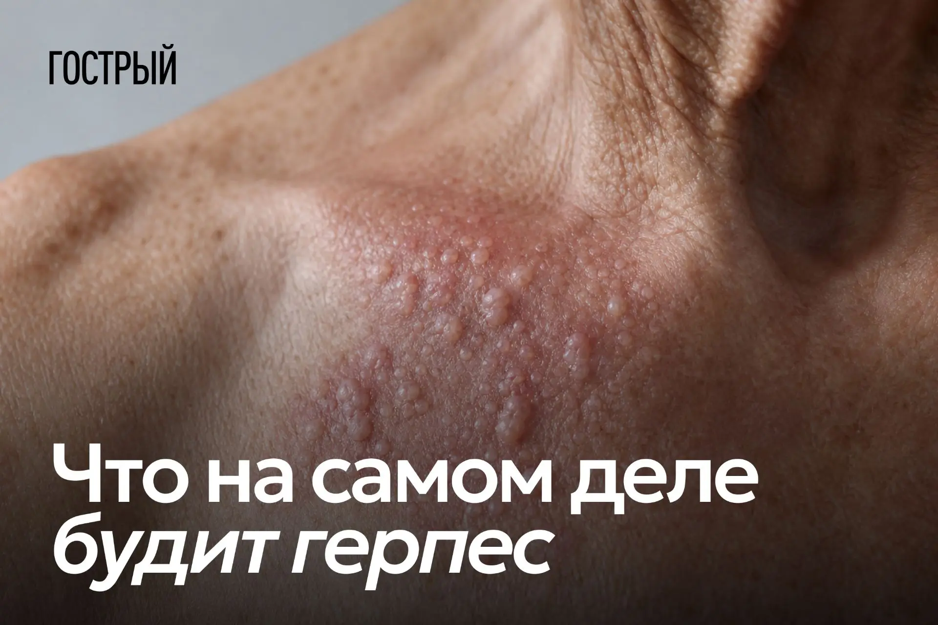 Герпес есть почти у всех. По разным оценкам, этим вирусом заражено от 40 до 90% людей в...